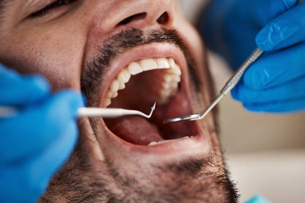 Best Emergency Dentist for Lost Fillings or Crowns in Bayfield, CO